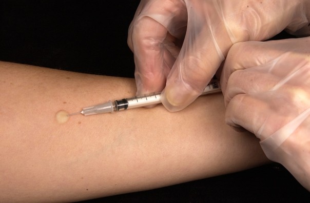 Test Mantoux per la tbc