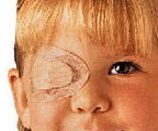 Una bambina affetta da ambliopia