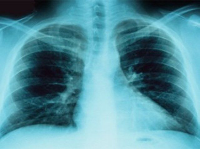 Tumore al polmone in aumento, a causa del fumo, tra le donne toscane