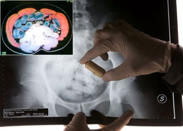 Lo spacciatore aveva inghiottito gli ovuli di cocaina